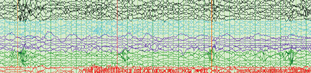 Clinical Neurophysiology and Epilepsy Fellowship