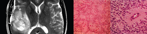 Neuro-Oncology Fellowship