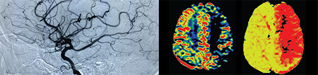 Vascular Neurology Fellowship